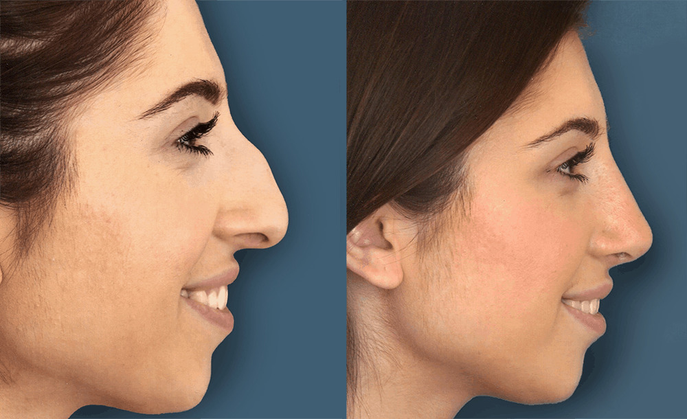 Why-Do-People-Prefer-Rhinoplasty-Surgery-in-India